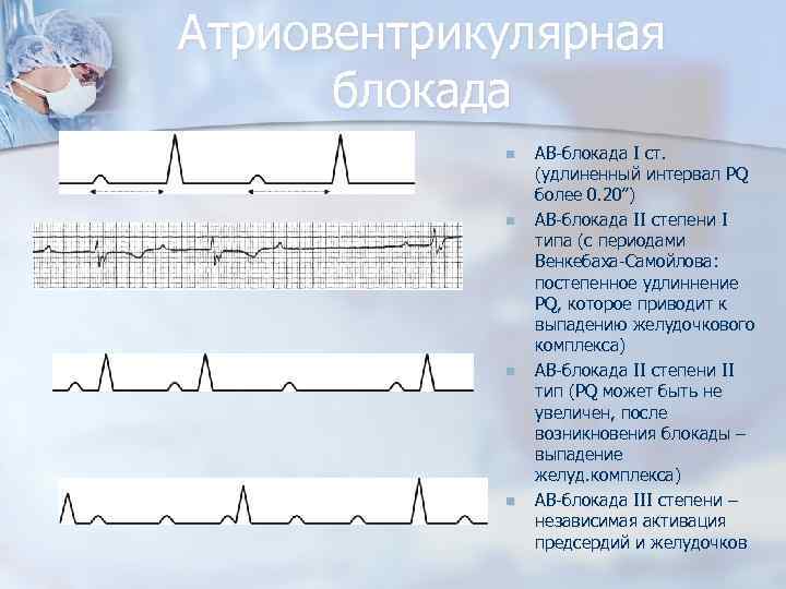 Атриовентрикулярная блокада n n АВ-блокада I ст. (удлиненный интервал PQ более 0. 20”) АВ-блокада