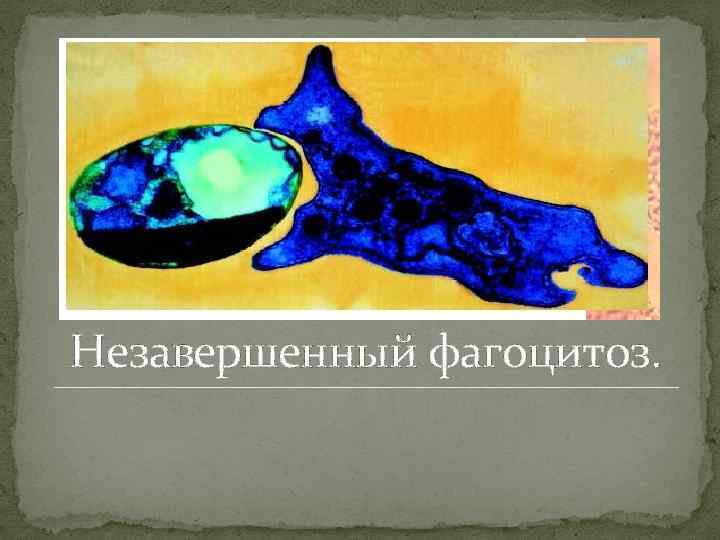 Незавершенный фагоцитоз. 