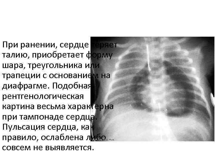 При ранении, сердце теряет талию, приобретает форму шара, треугольника или трапеции с основанием на