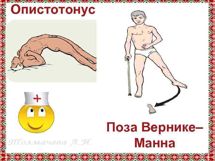 Опистотонус Поза Вернике– Манна 