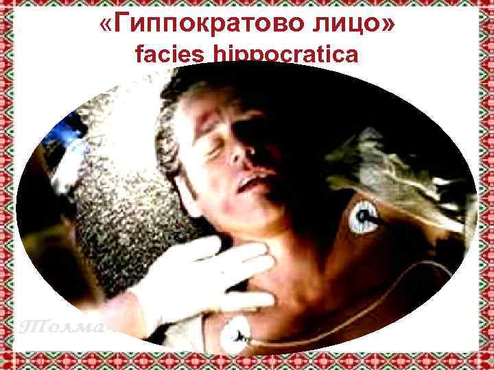  «Гиппократово лицо» facies hippocratica 