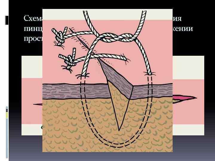 Схематическое изображение сопоставления пинцетами краев кожной раны при наложении простого узлового шва. 