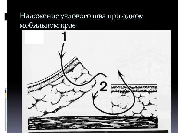 Наложение узлового шва при одном мобильном крае 