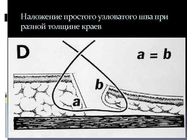 Наложение простого узловатого шва при разной толщине краев 