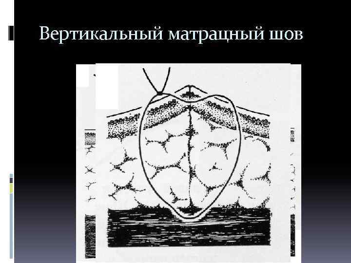 Вертикальный матрацный шов 