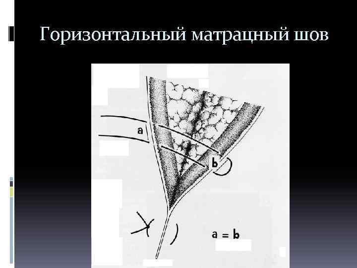 Горизонтальный матрацный шов 