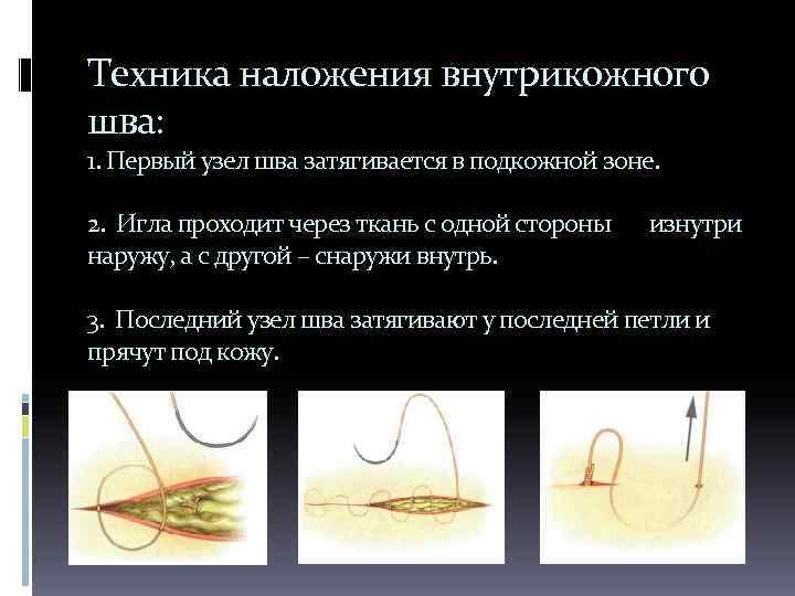 Техника наложения внутрикожного шва: 1. Первый узел шва затягивается в подкожной зоне. 2. Игла