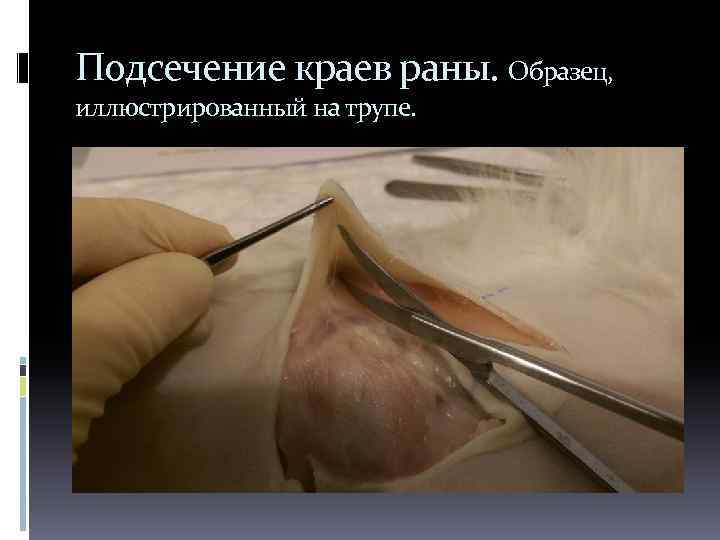 Подсечение краев раны. Образец, иллюстрированный на трупе. 