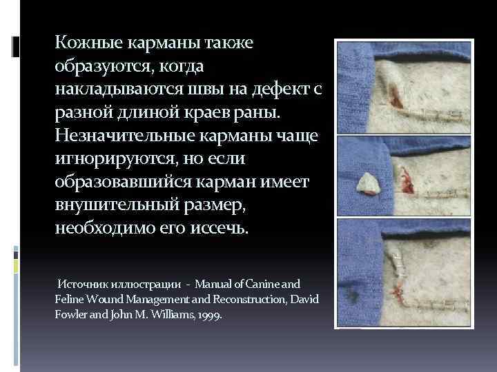 Кожные карманы также образуются, когда накладываются швы на дефект с разной длиной краев раны.