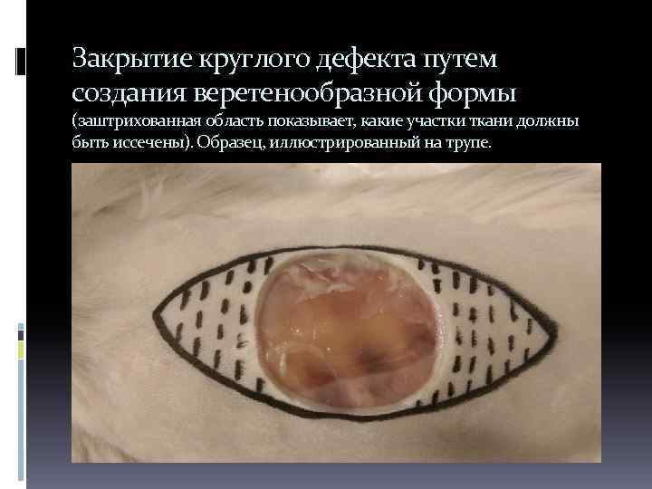 Закрытие круглого дефекта путем создания веретенообразной формы (заштрихованная область показывает, какие участки ткани должны