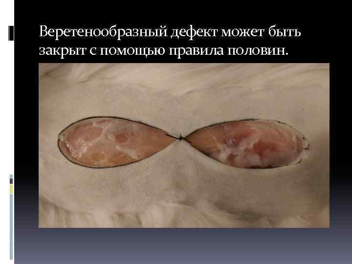 Веретенообразный дефект может быть закрыт с помощью правила половин. 