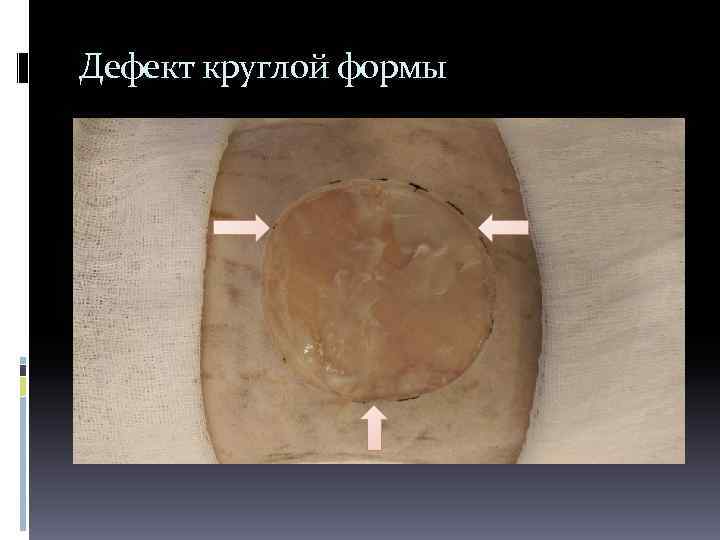 Дефект круглой формы 