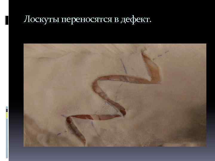 Лоскуты переносятся в дефект. 