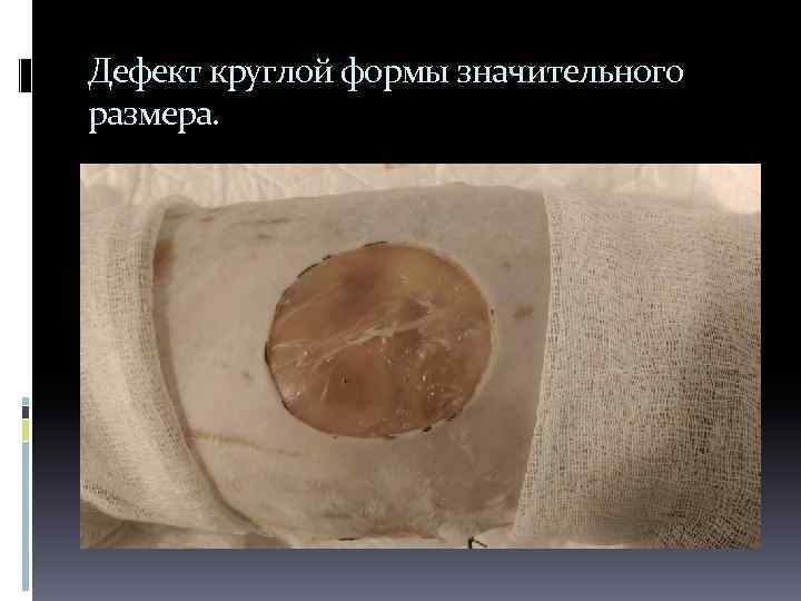 Дефект круглой формы значительного размера. 