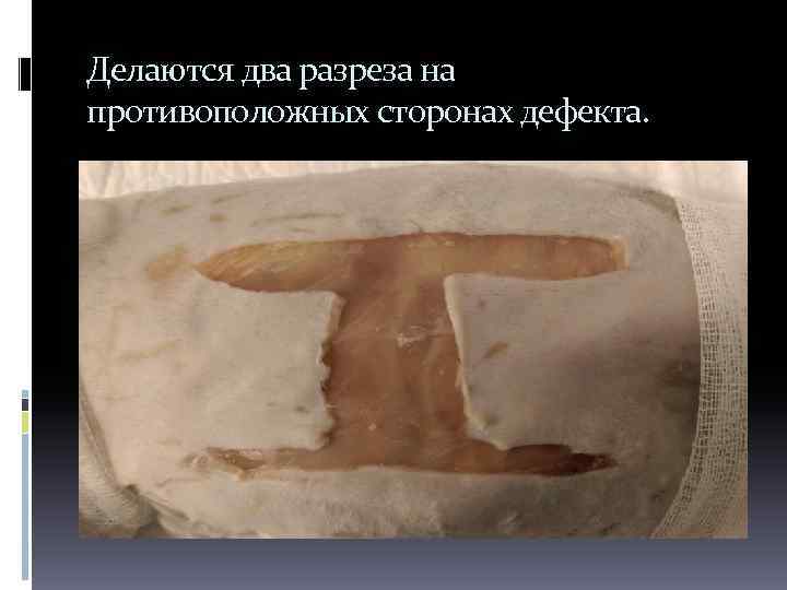 Делаются два разреза на противоположных сторонах дефекта. 
