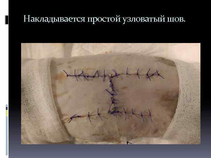 Накладывается простой узловатый шов. 