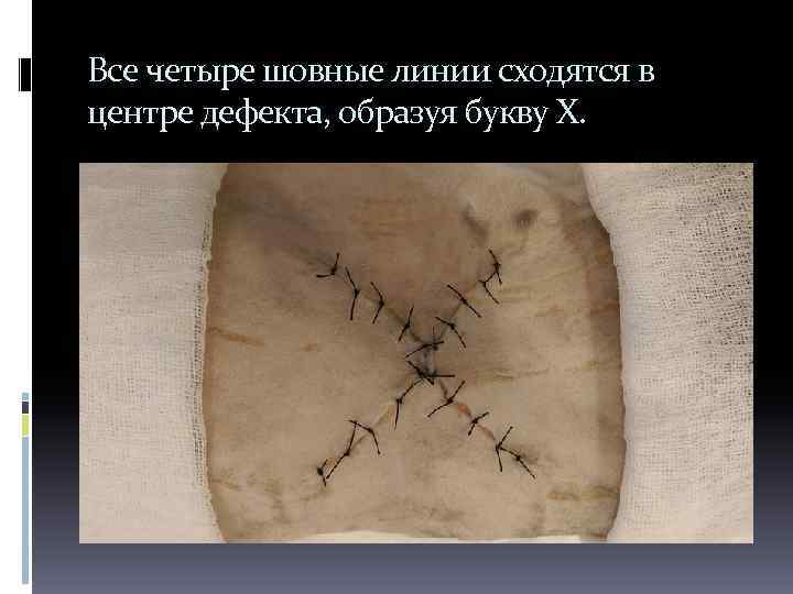 Все четыре шовные линии сходятся в центре дефекта, образуя букву X. 