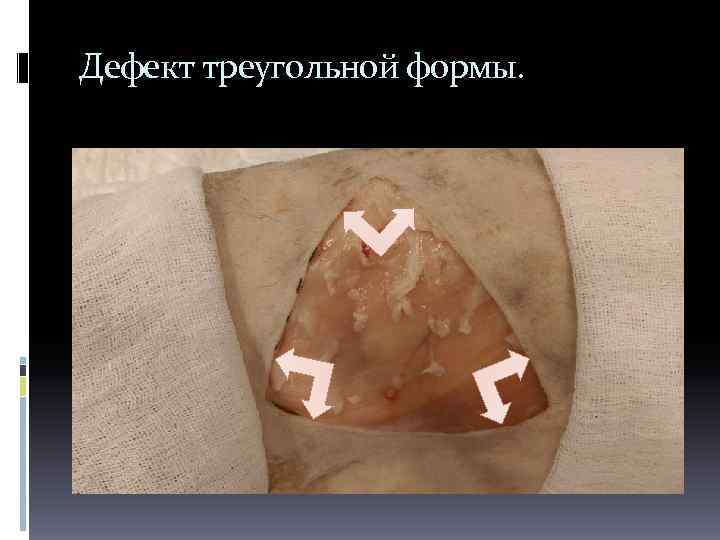 Дефект треугольной формы. 