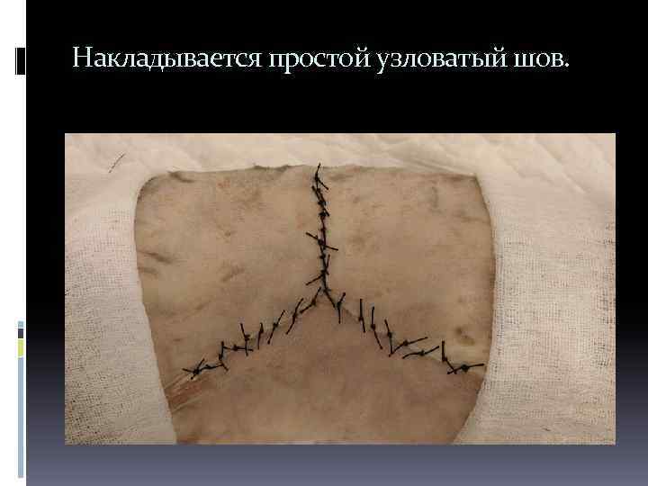 Накладывается простой узловатый шов. 