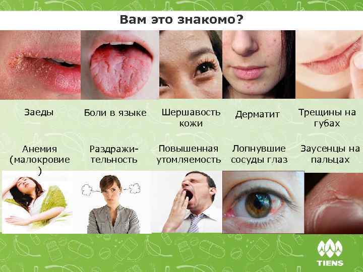 Вам это знакомо? Заеды Боли в языке Анемия (малокровие ) Раздражительность Шершавость кожи Дерматит