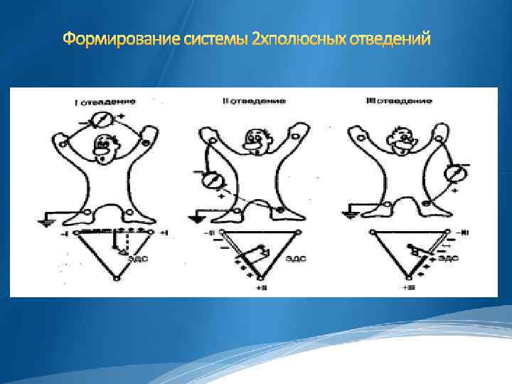 Формирование системы 2 хполюсных отведений 