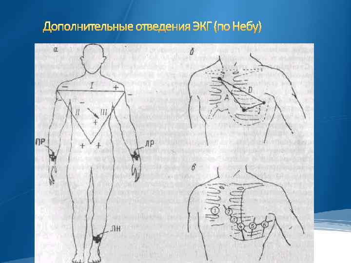 Дополнительные отведения ЭКГ (по Небу) 