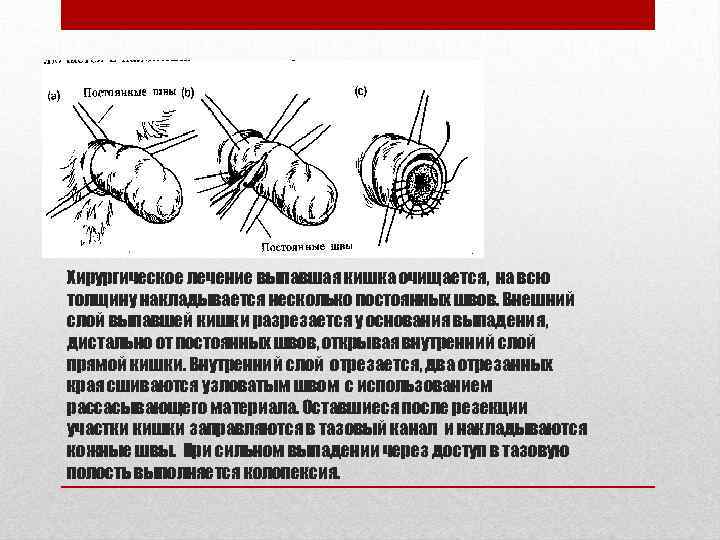 Хирургическое лечение выпавшая кишка очищается, на всю толщину накладывается несколько постоянных швов. Внешний слой