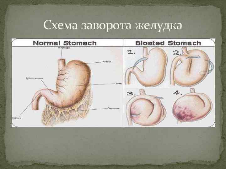 Схема заворота желудка 