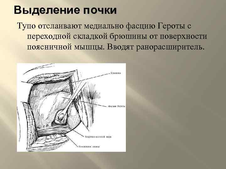 Выделение почки Тупо отслаивают медиально фасцию Героты с переходной складкой брюшины от поверхности поясничной