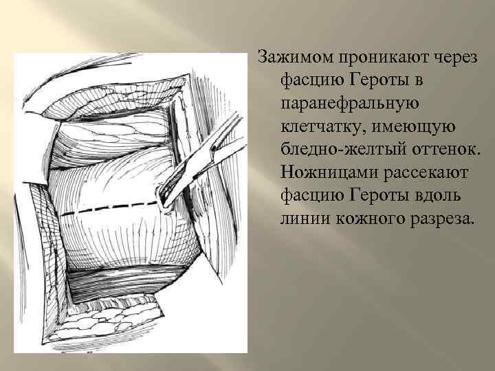 Зажимом проникают через фасцию Героты в паранефральную клетчатку, имеющую бледно-желтый оттенок. Ножницами рассекают фасцию