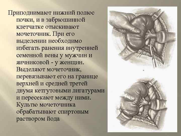 Приподнимают нижний полюс почки, и в забрюшинной клетчатке отыскивают мочеточник. При его выделении необходимо