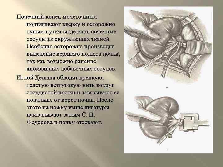 Почечный конец мочеточника подтягивают кверху и осторожно тупым путем выделяют почечные сосуды из окружающих