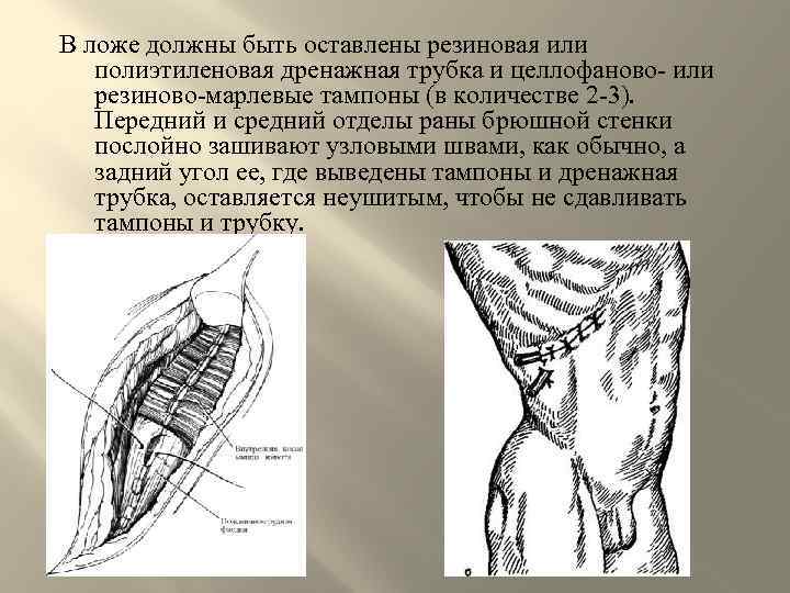 В ложе должны быть оставлены резиновая или полиэтиленовая дренажная трубка и целлофаново- или резиново-марлевые