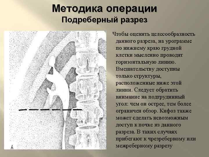 Методика операции Подреберный разрез Чтобы оценить целесообразность данного разреза, на урограмме по нижнему краю