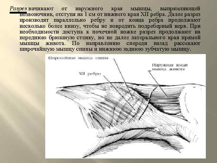 Разрез начинают от наружного края мышцы, выпрямляющей позвоночник, отступя на 1 см от нижнего