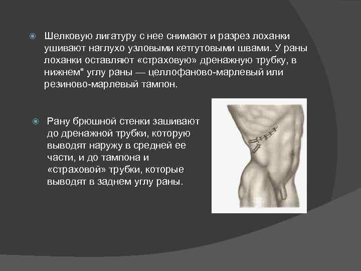  Шелковую лигатуру с нее снимают и разрез лоханки ушивают наглухо узловыми кетгутовыми швами.