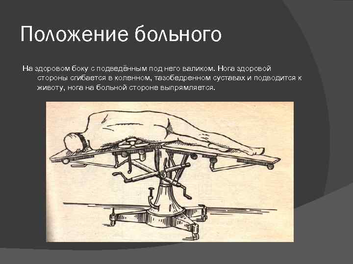 Положение больного На здоровом боку с подведённым под него валиком. Нога здоровой стороны сгибается