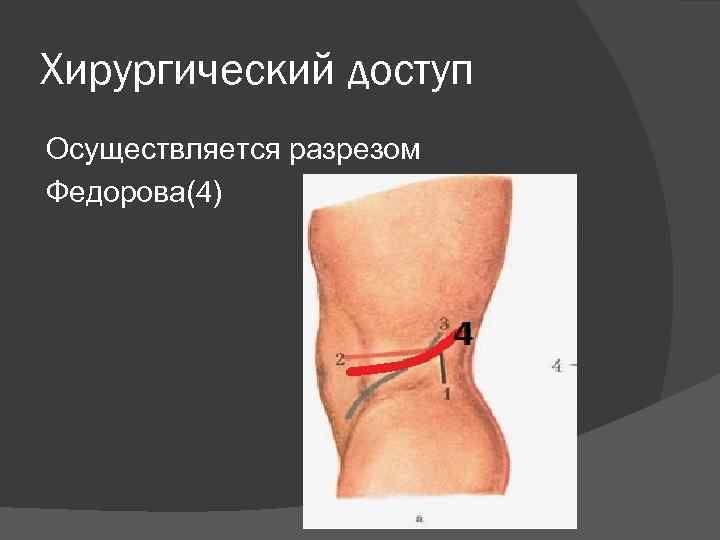 Хирургический доступ Осуществляется разрезом Федорова(4) 