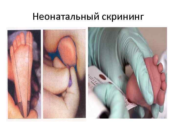 Неонатальный скрининг 