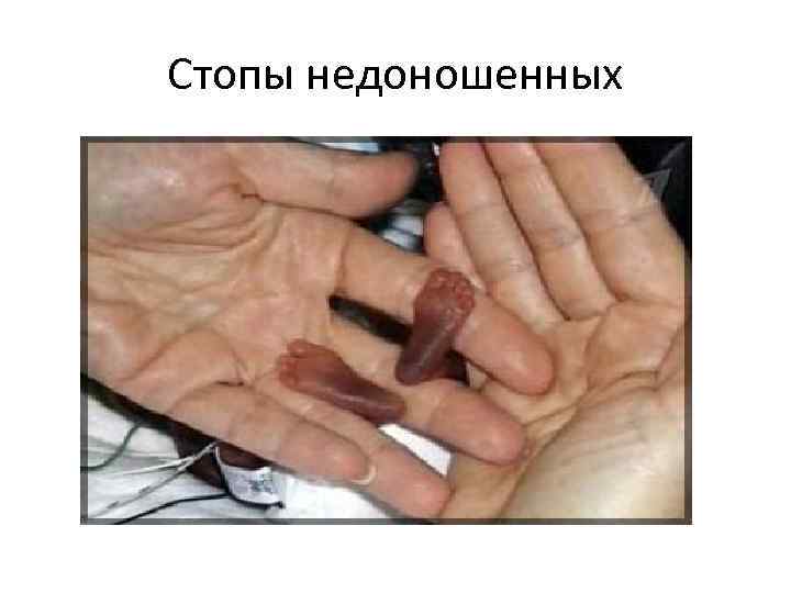 Стопы недоношенных 