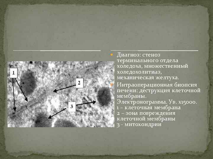  Диагноз: стеноз терминального отдела холедоха, множественный холедохолитиаз, механическая желтуха. Интраоперационная биопсия печени: деструкция