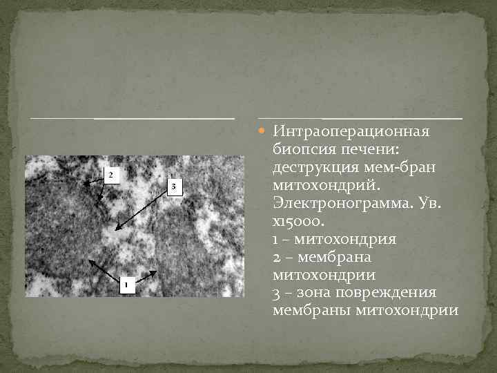  Интраоперационная биопсия печени: деструкция мем-бран митохондрий. Электронограмма. Ув. х15000. 1 – митохондрия 2