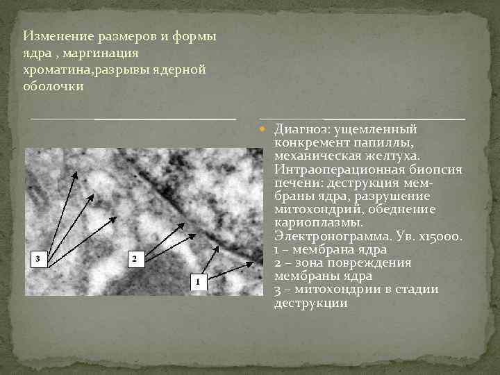 Изменение размеров и формы ядра , маргинация хроматина, разрывы ядерной оболочки Диагноз: ущемленный конкремент