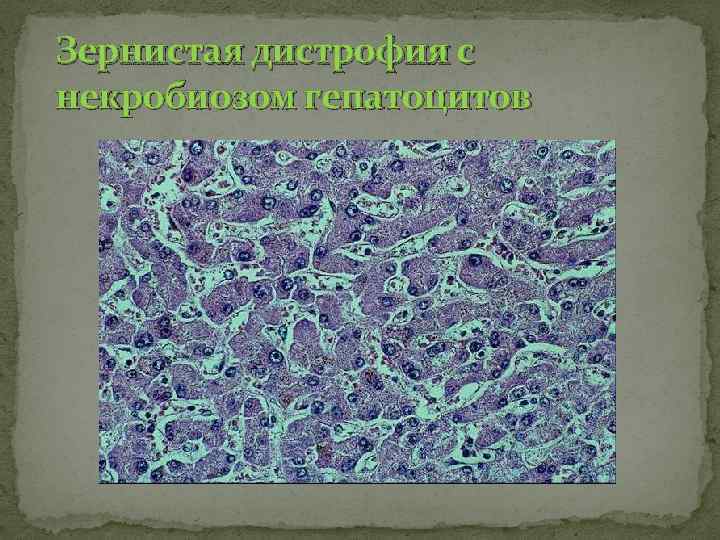 Зернистая дистрофия с некробиозом гепатоцитов 