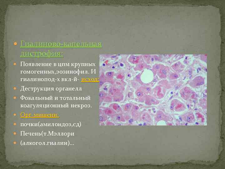  Гиалиново-капельная дистрофия: Появление в цпм крупных гомогенных, эозинофил. И гиалинопод-х вкл-й- исход: Деструкция
