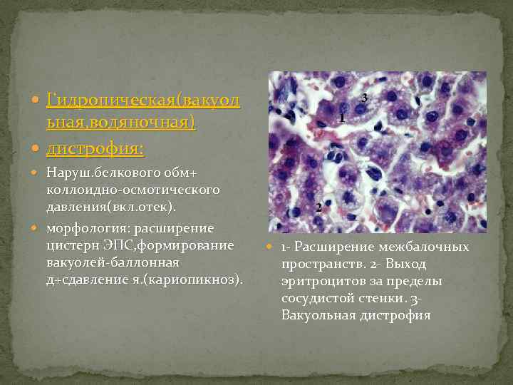 Отечность клеток. Гидропическая дистрофия. Коллоидная дистрофия щитовидной железы. Слизистая (коллоидная) дистрофия.