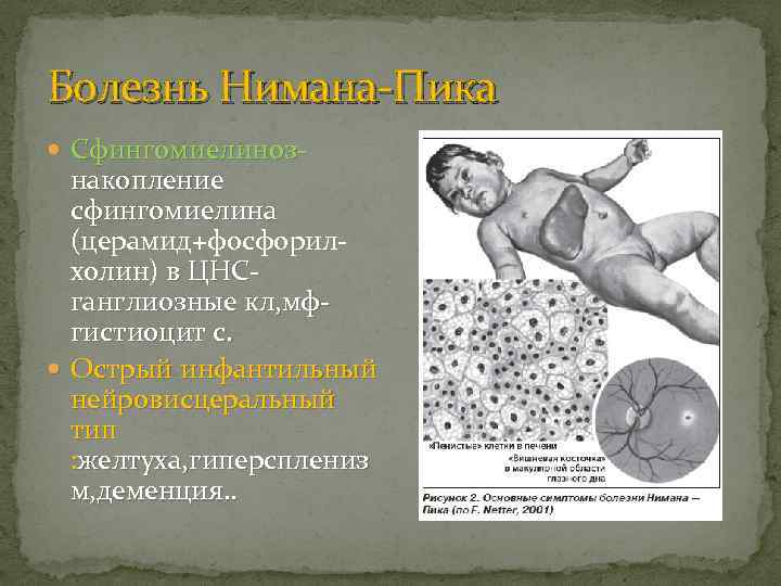 Болезнь Нимана-Пика Сфингомиелиноз- накопление сфингомиелина (церамид+фосфорилхолин) в ЦНСганглиозные кл, мфгистиоцит с. Острый инфантильный нейровисцеральный