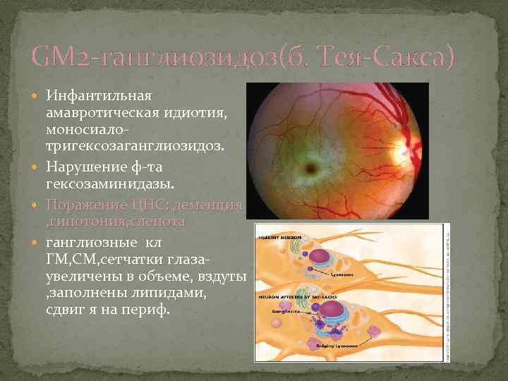 GM 2 -ганглиозидоз(б. Тея-Сакса) Инфантильная амавротическая идиотия, моносиалотригексозаганглиозидоз. Нарушение ф-та гексозаминидазы. Поражение ЦНС: деменция