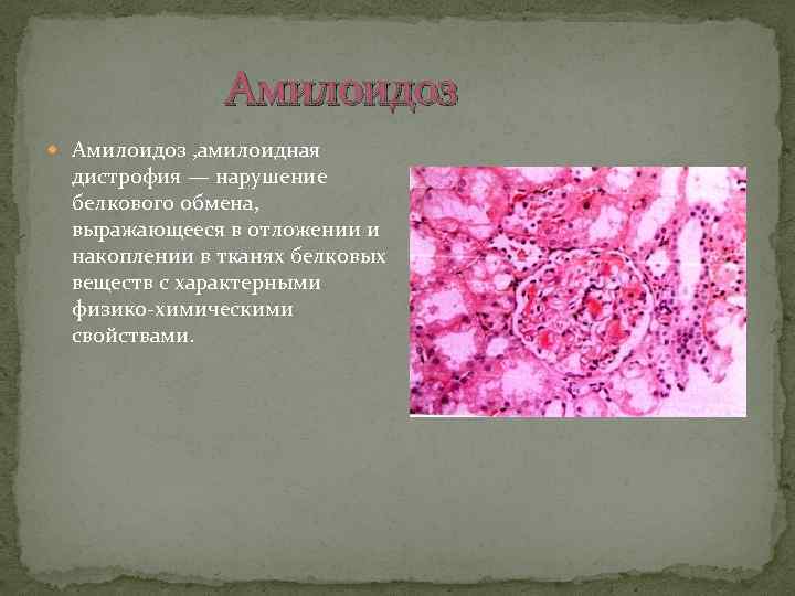  Амилоидоз , амилоидная дистрофия — нарушение белкового обмена, выражающееся в отложении и накоплении