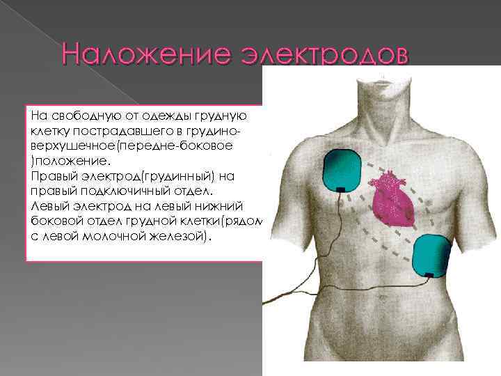 Наложение электродов На свободную от одежды грудную клетку пострадавшего в грудиноверхушечное(передне-боковое )положение. Правый электрод(грудинный)